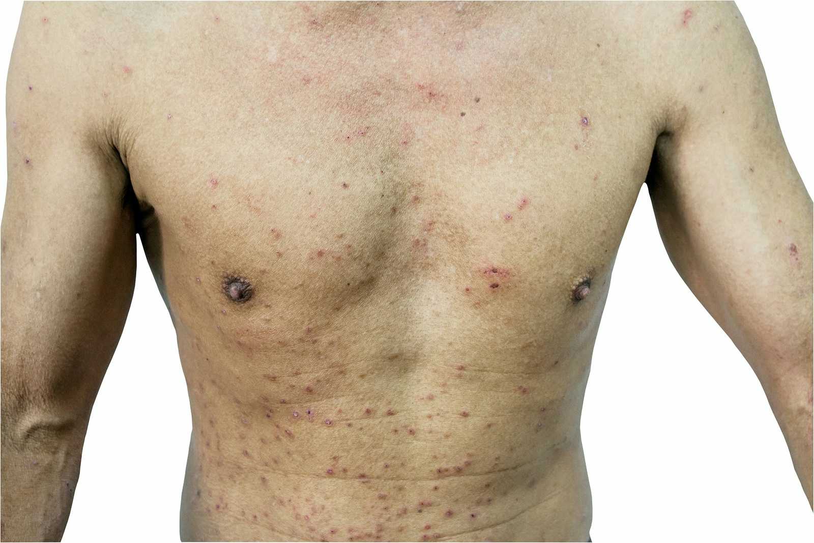 Here's when to worry about a rash in adults - VSM Pharmacy