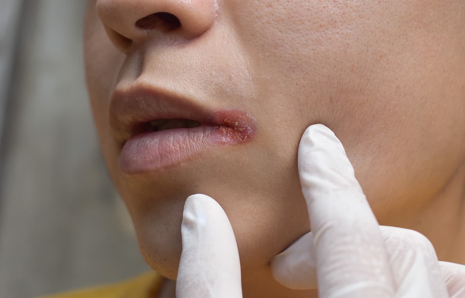 dermatologist demonstrating angular cheilitis on patient