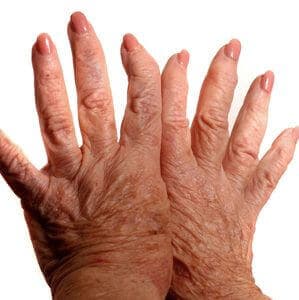 Hands With Arthritis