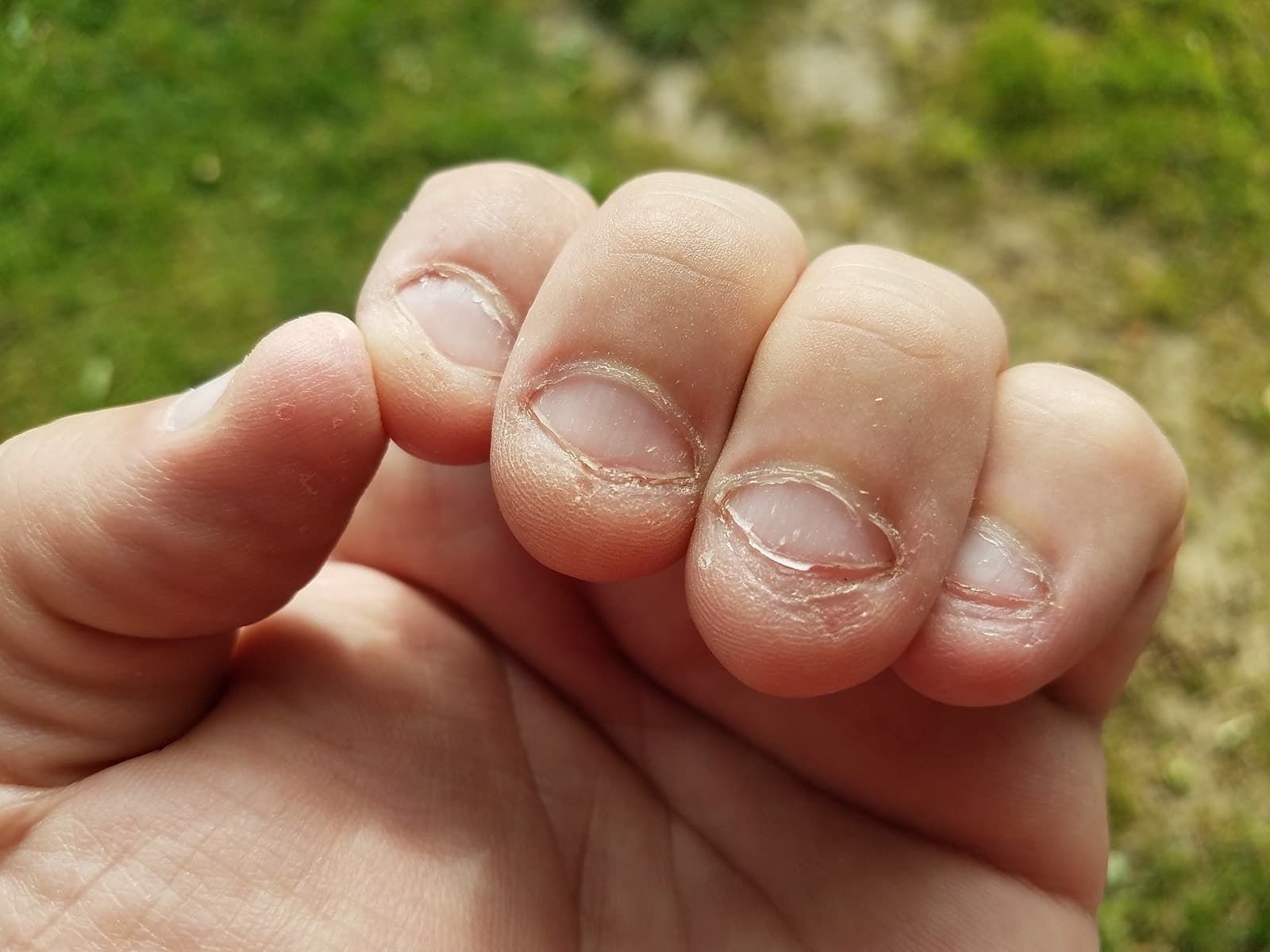 nasty nails that have been bitten down to the quick