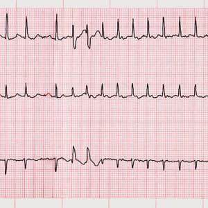 ECG of A-Fib, atrial fibrillation