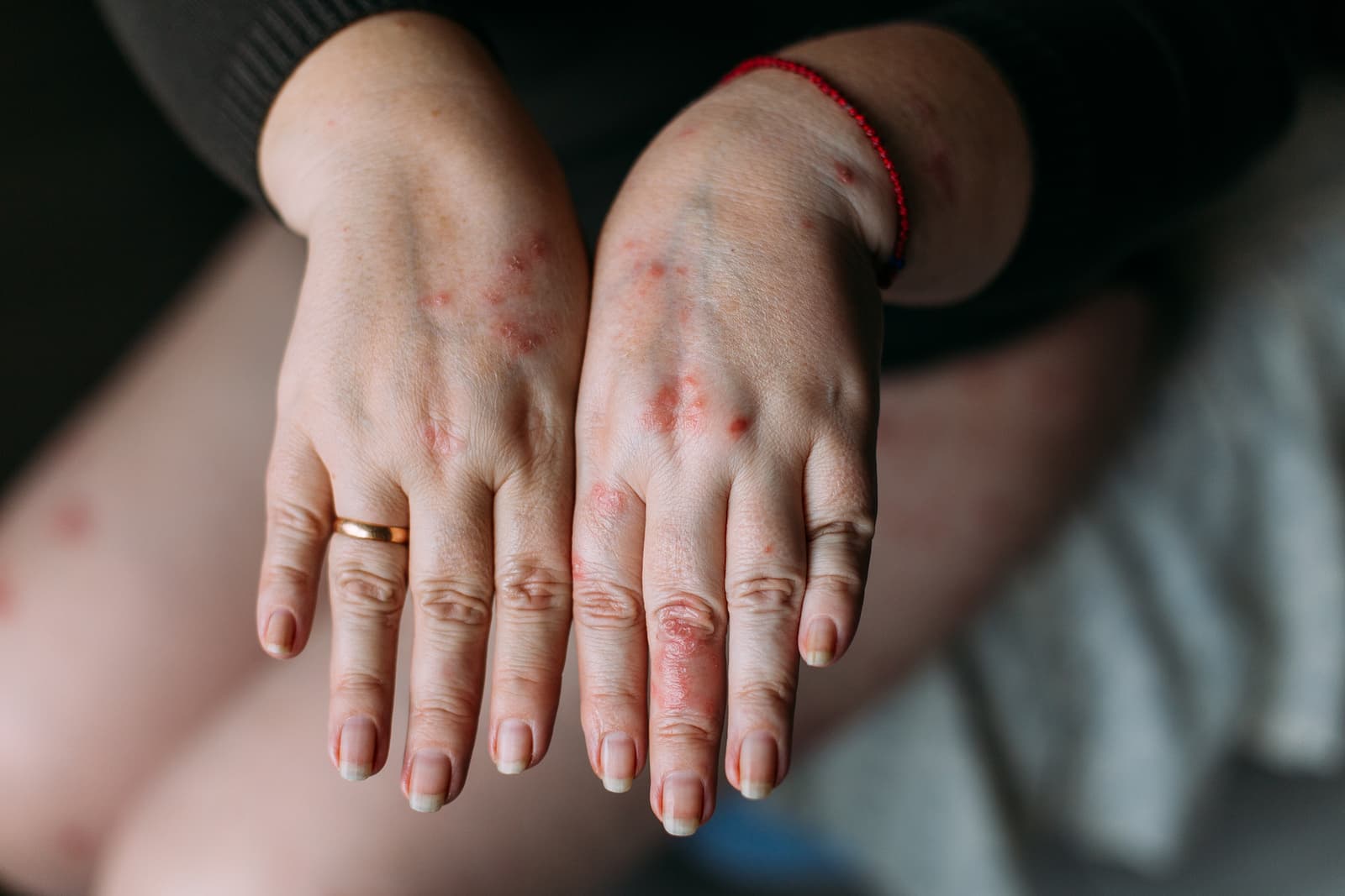 hand with eczema red patches on fingers