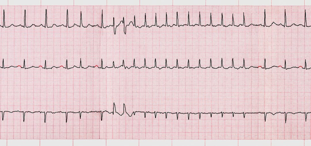Emergency Cardiology. ECG with supraventricular arrhythmias and short paroxysm of atrial fibrillation

