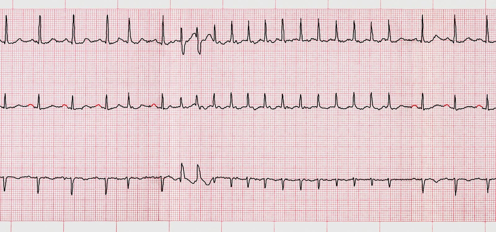 An electrocardiogram with evidence of atrial fibrillation, irregular heart rhythm