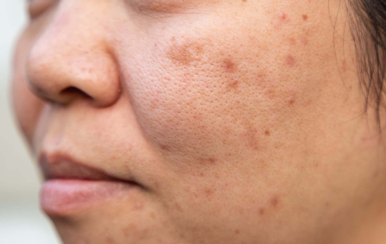middle aged woman with stubborn blemishes on her cheeks