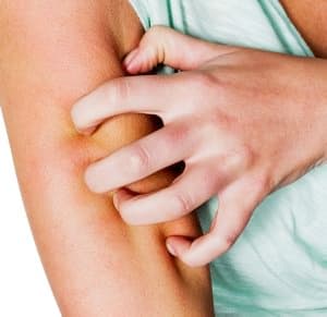 A woman has after a mosquito bite a itchy skin and scratching

