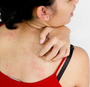 Young woman's back has unbelievable itching with allergy skin problem