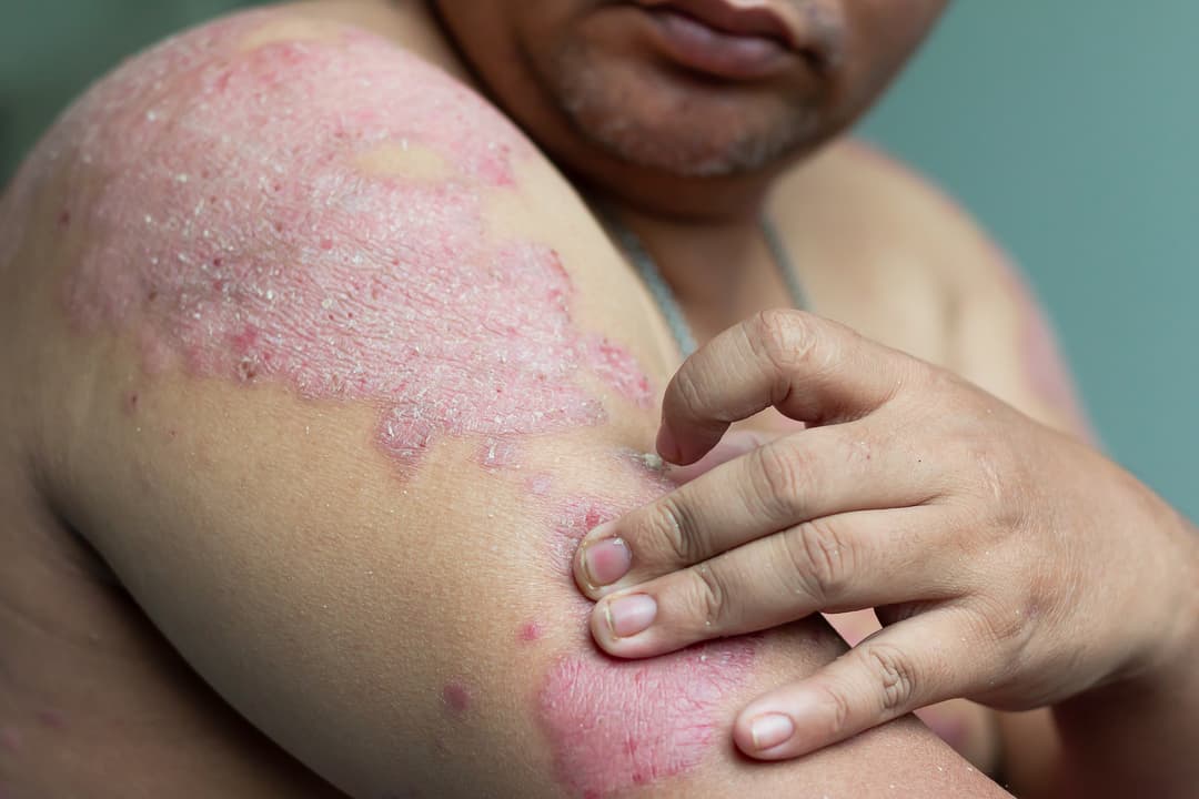 People with psoriasis look at their arms full of wounds and scratches. Diseases caused by abnormalities of the lymph. Psoriasis is a skin disease. Select focus shallow depth of field and blurred background
