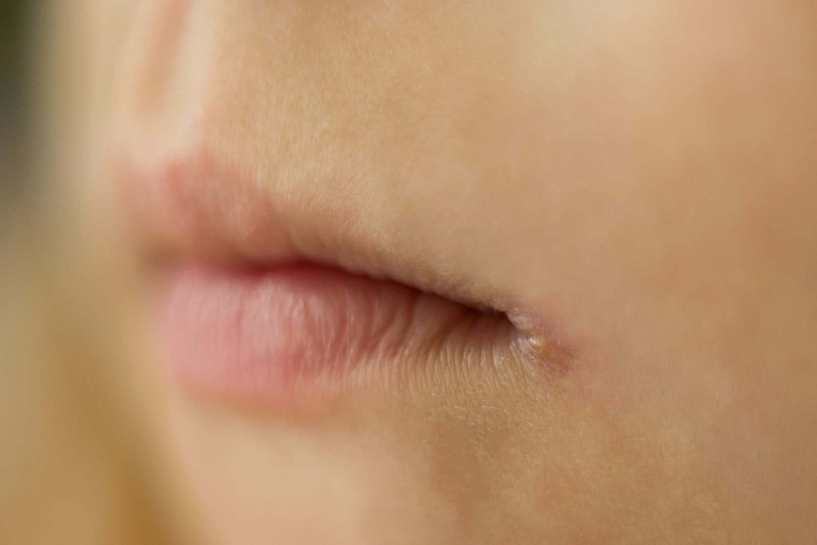 angular cheilitis