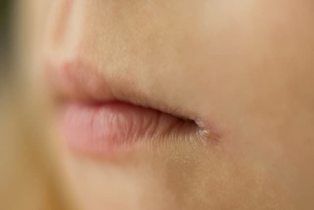 Do You Need Advice on Angular Cheilitis? | The People's Pharmacy
