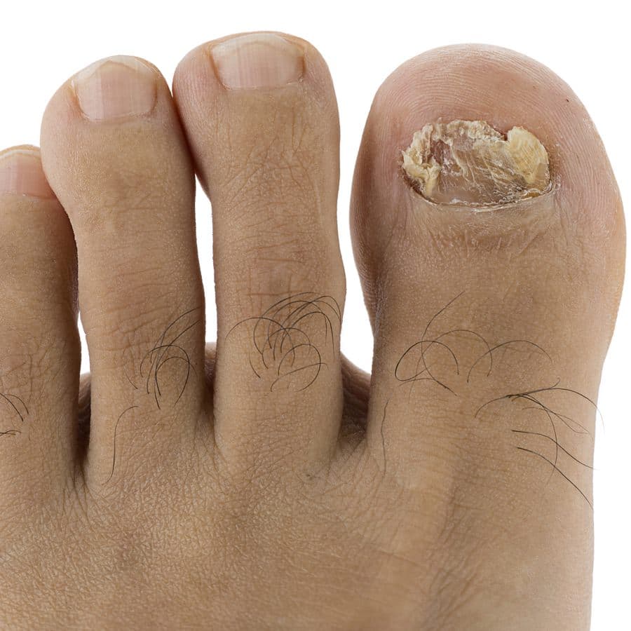 Should You Be Peeing on Your Feet? The People's Pharmacy