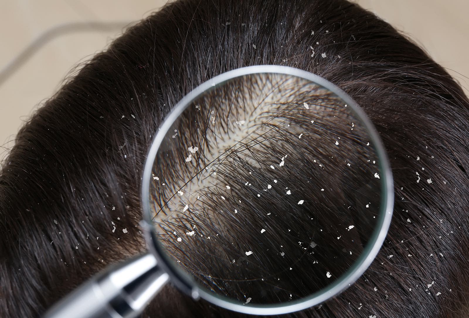 woman with dandruff in her hair