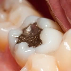Macro of a tooth with amalgam filling
