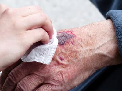 a cut on a hand