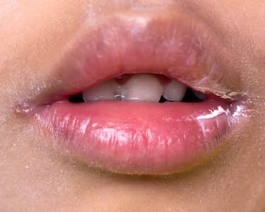 perleche or angular cheilitis, cracks in the corners of the mouth