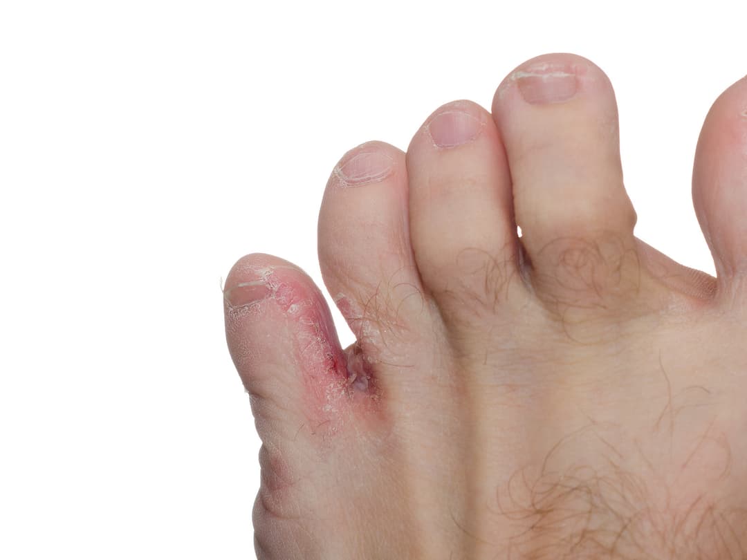 Athlete&#8217;s foot (tinea pedis) between toes isolated on white background
