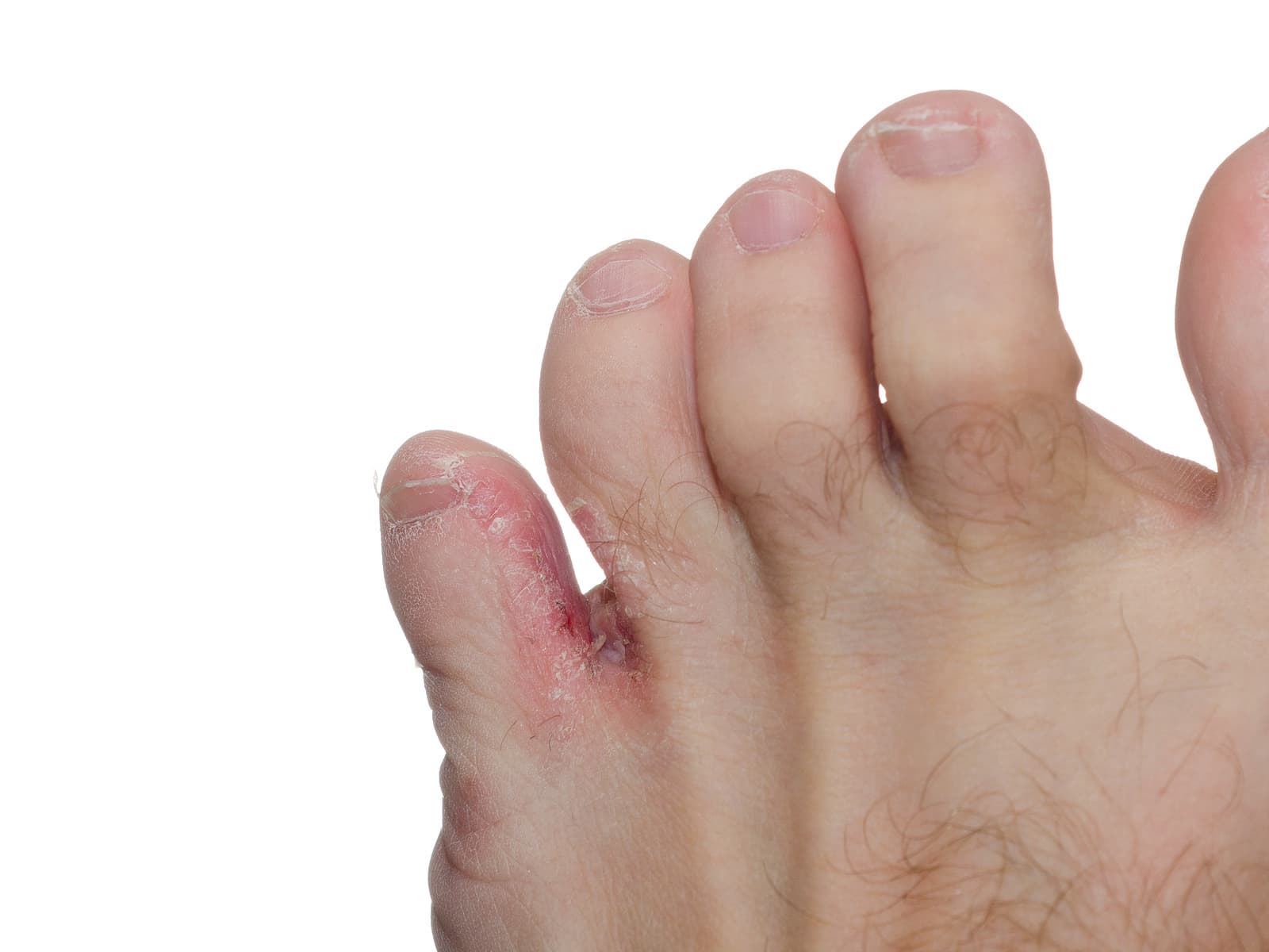 foot with athlete's foot on pinky toe