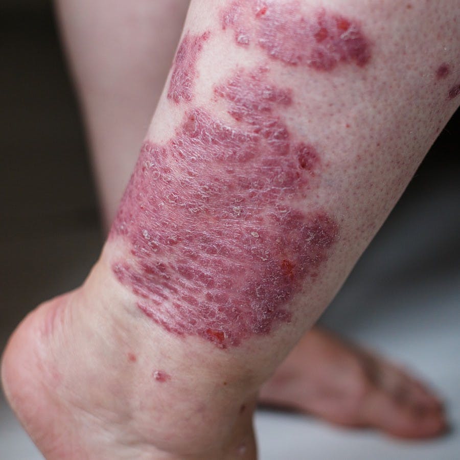 Close up of bad eczema rash, atopic dermatitis, on a women's leg