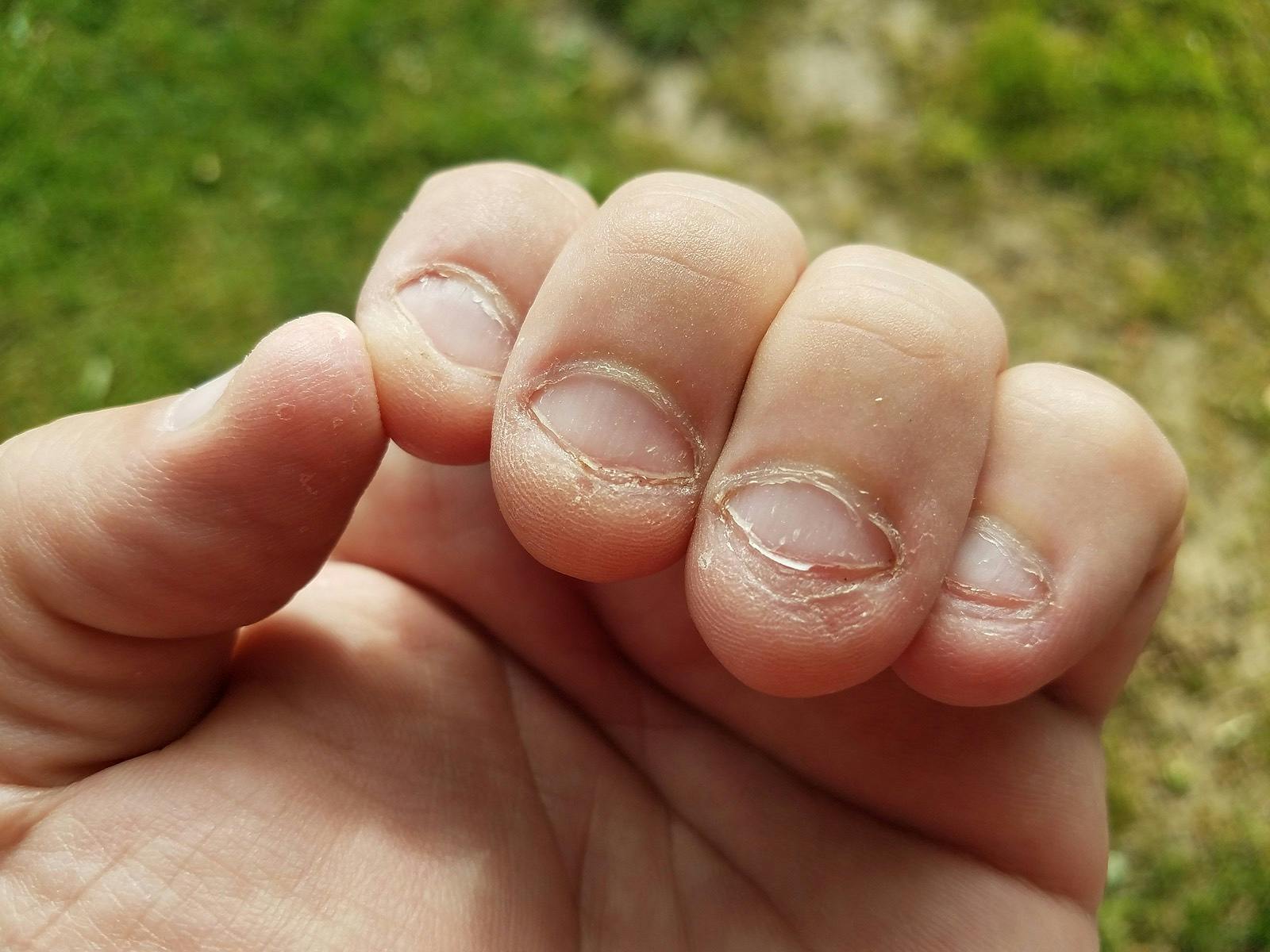 Bitten nasty unhealthy gross chewed fingernails bad habit
