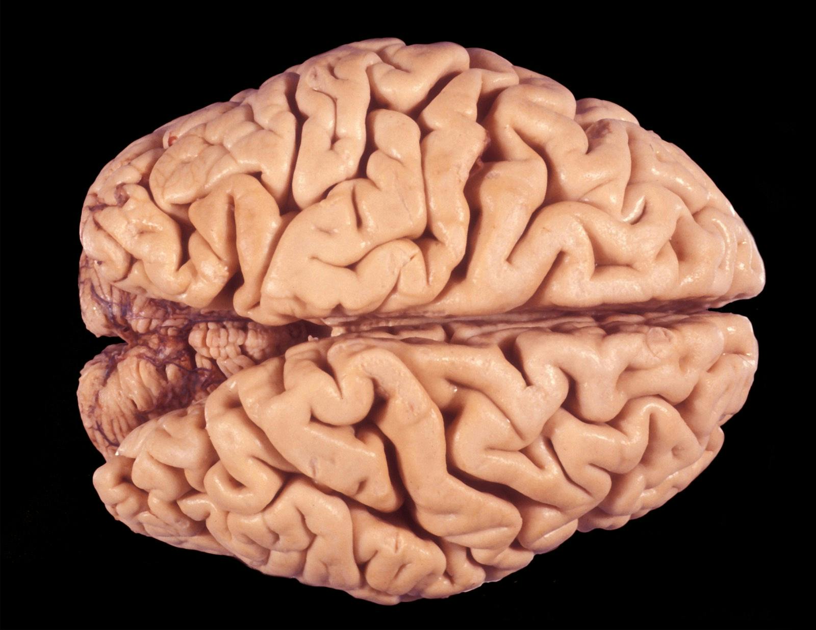 Gross anatomy of the dorsal surface of a human brain (fixed in formalin) showing a severe cortical atrophy with enlarged sulci and reduced giri. This aspect can be seen in Alzheimer disease or senile brain.
