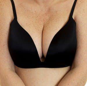 Irritating, Embarrassing Rash Under Breasts Can Be Managed with