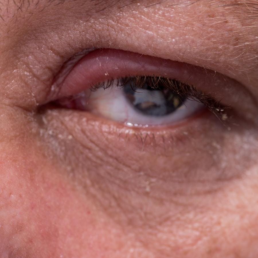 Close up of eye infection with swollen eyelid, blepharitis