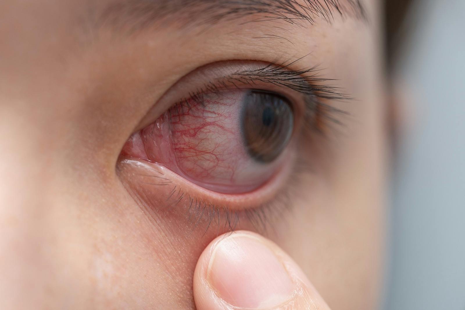 Closeup of irritated or infected red bloodshot eye &#8211; conjunctivitis. Red eye of woman, conjunctivitis eye, allergy or after cry.
