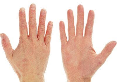 Eczema Dermatitis onFront and Back of Hand and Fingers
