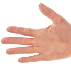 Eczema Dermatitis on Palm of Hand and Fingers
