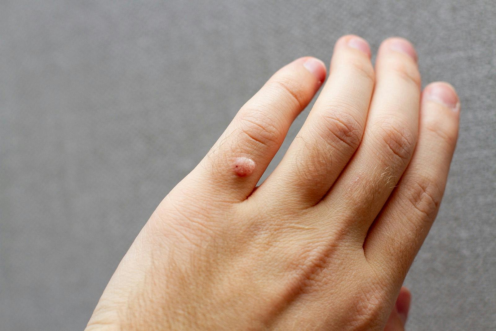 wart on finger of left hand