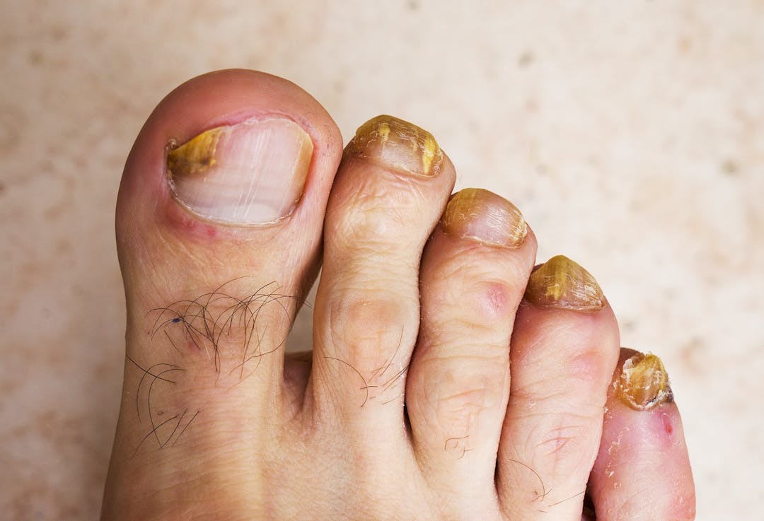 Fungus infection on nails of mans foot.
