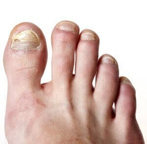 toes with unsightly nail fungus