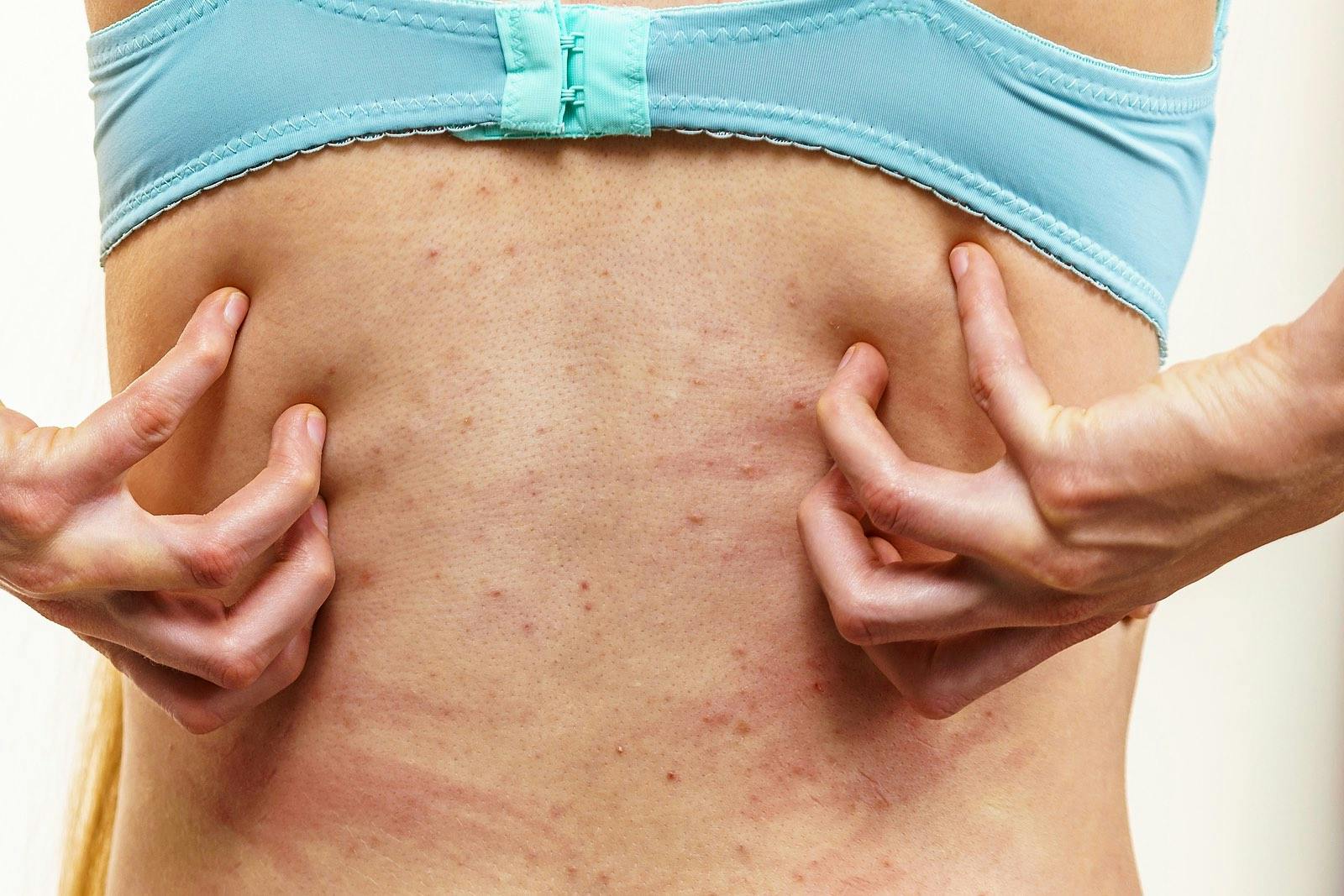 Itchy skin, dermatitis, food allergies. Woman showing her back with acne, red spots. Female having itching, scratching her body with allergy rash.
