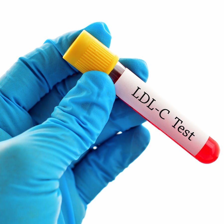 Test tube with blood sample for LDL-Cholesterol (LDL-C) test
