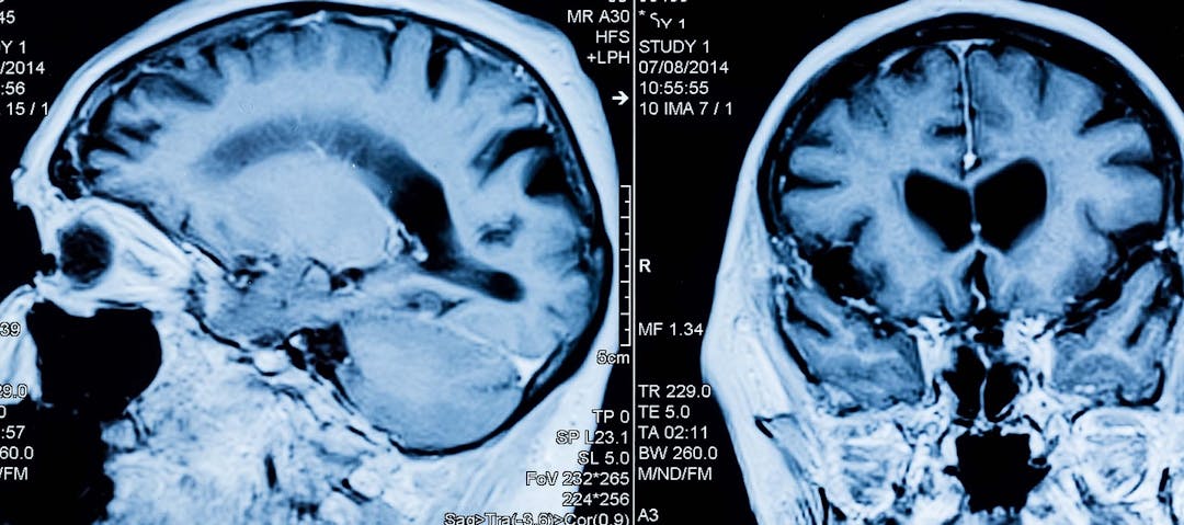 MRI Head Scan MRI Head Scan
