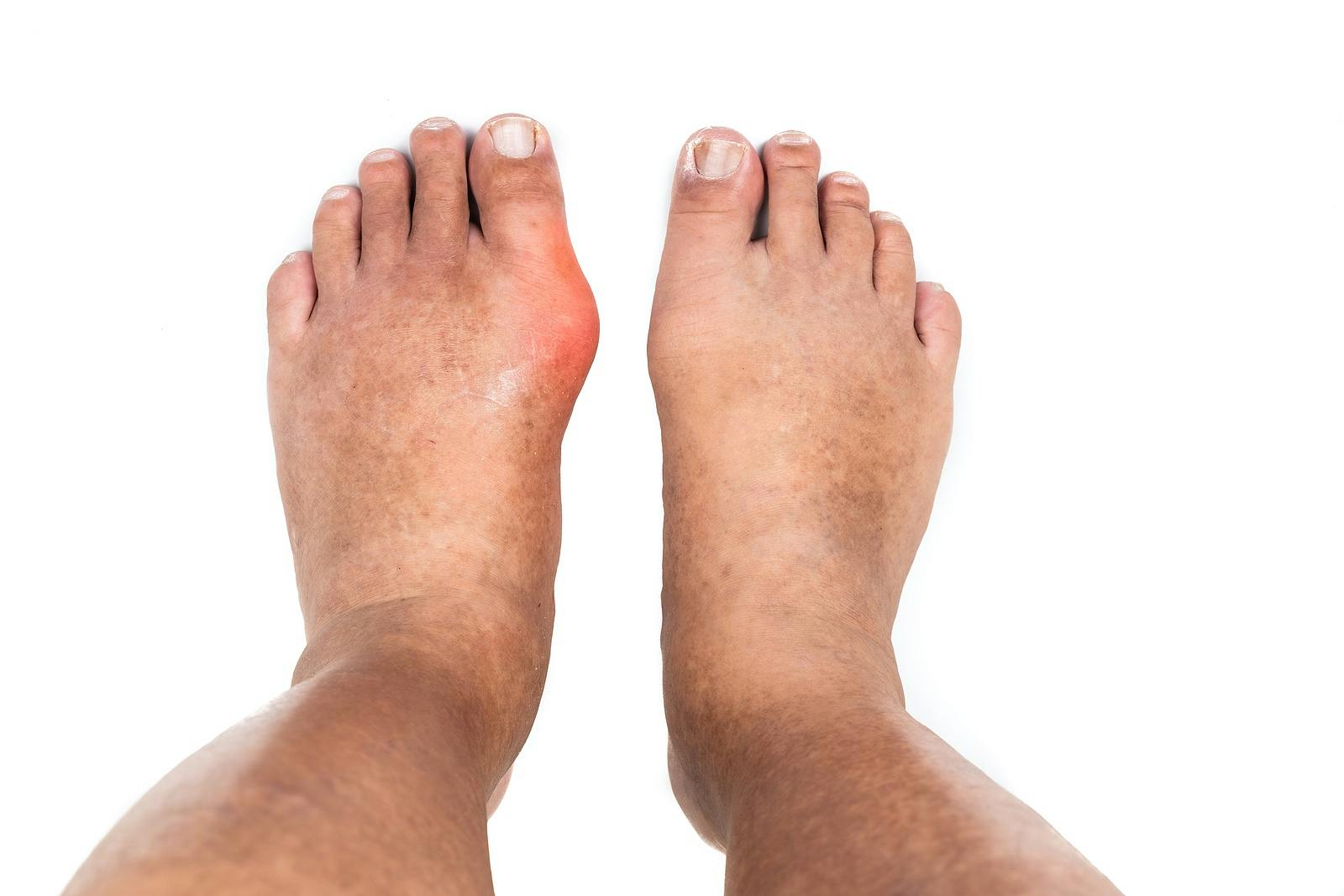 Man with swollen deformed inflammed left foot toe joint with painful gout
