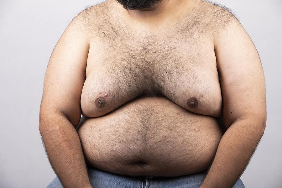 Overweight man with gynecomastia-enlarged breasts