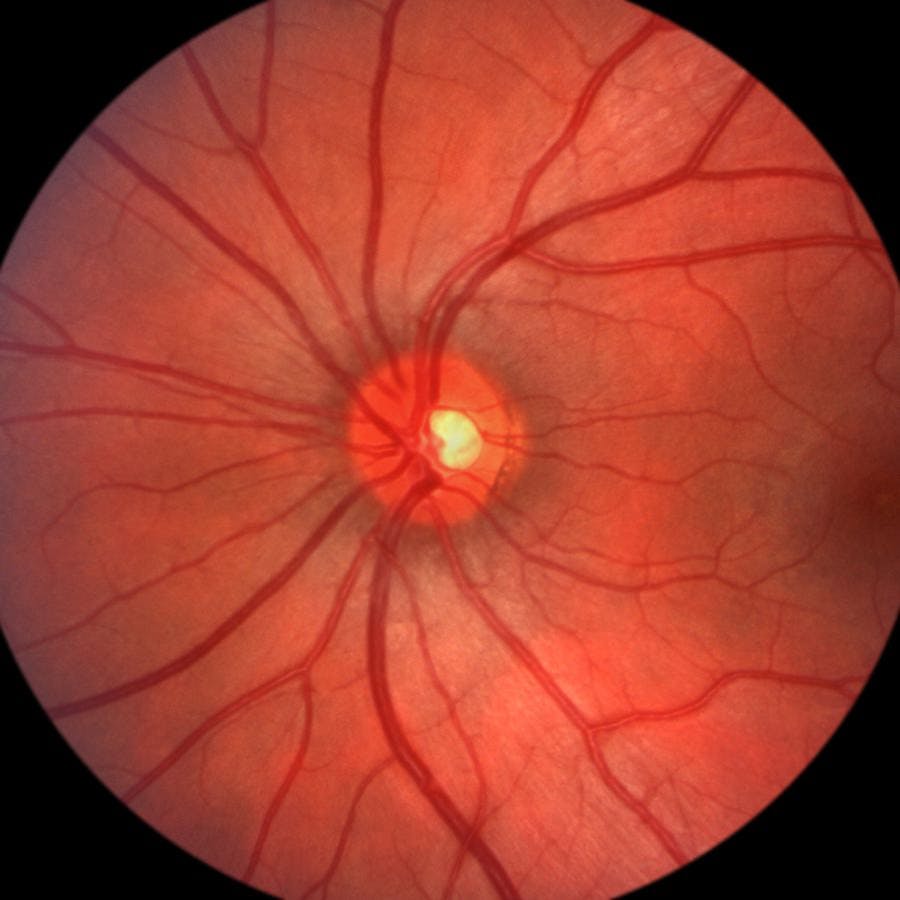 Ophthalmic image detailing the retina and optic nerve inside a healthy human eye
