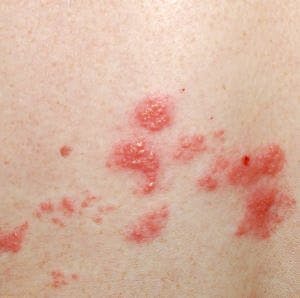 Herpes zoster shingles pain rash
