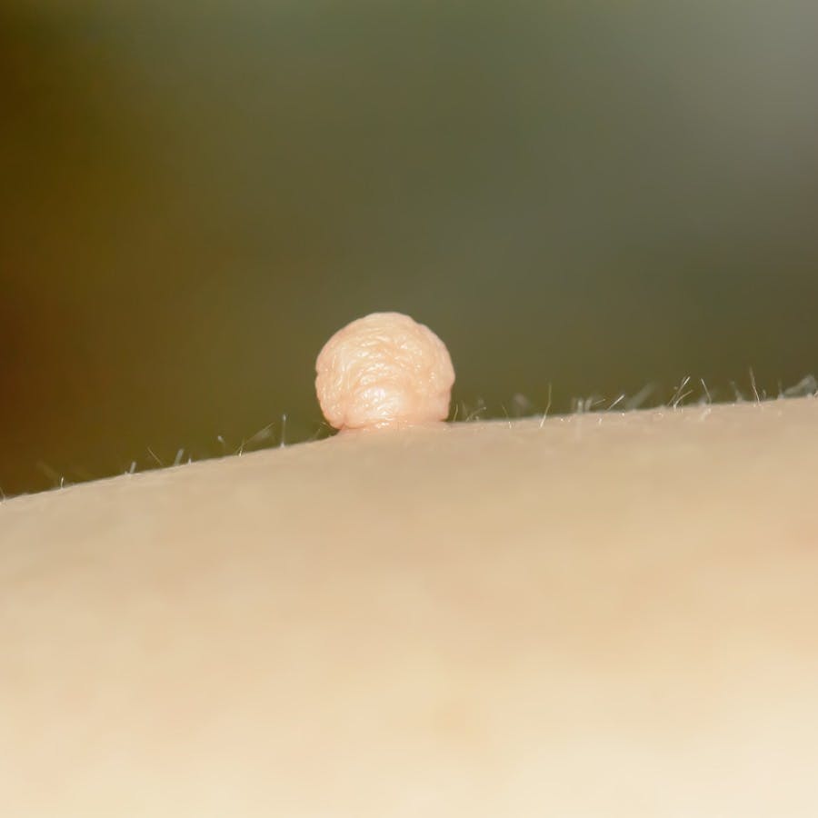 Skin tag or acrochondon or soft fibroma is a safe. It have not effect to the body. It usually occurs at neck face armpits and body.
