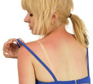 woman with a sunburn on her back