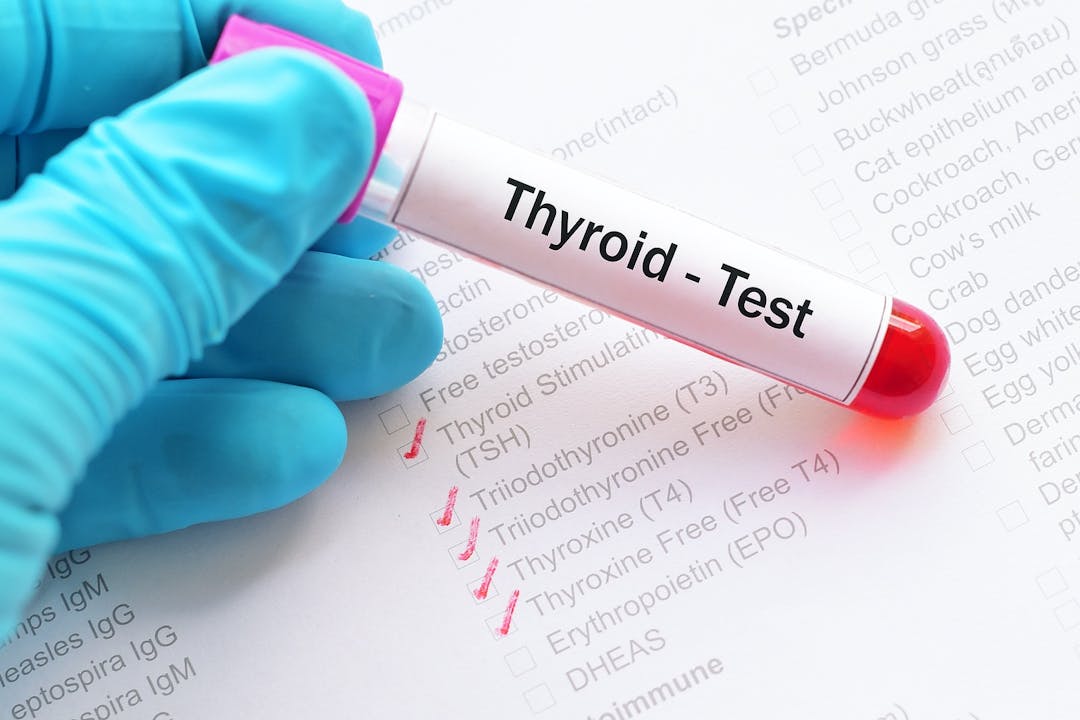 Test tube with blood sample for thyroid hormone test
