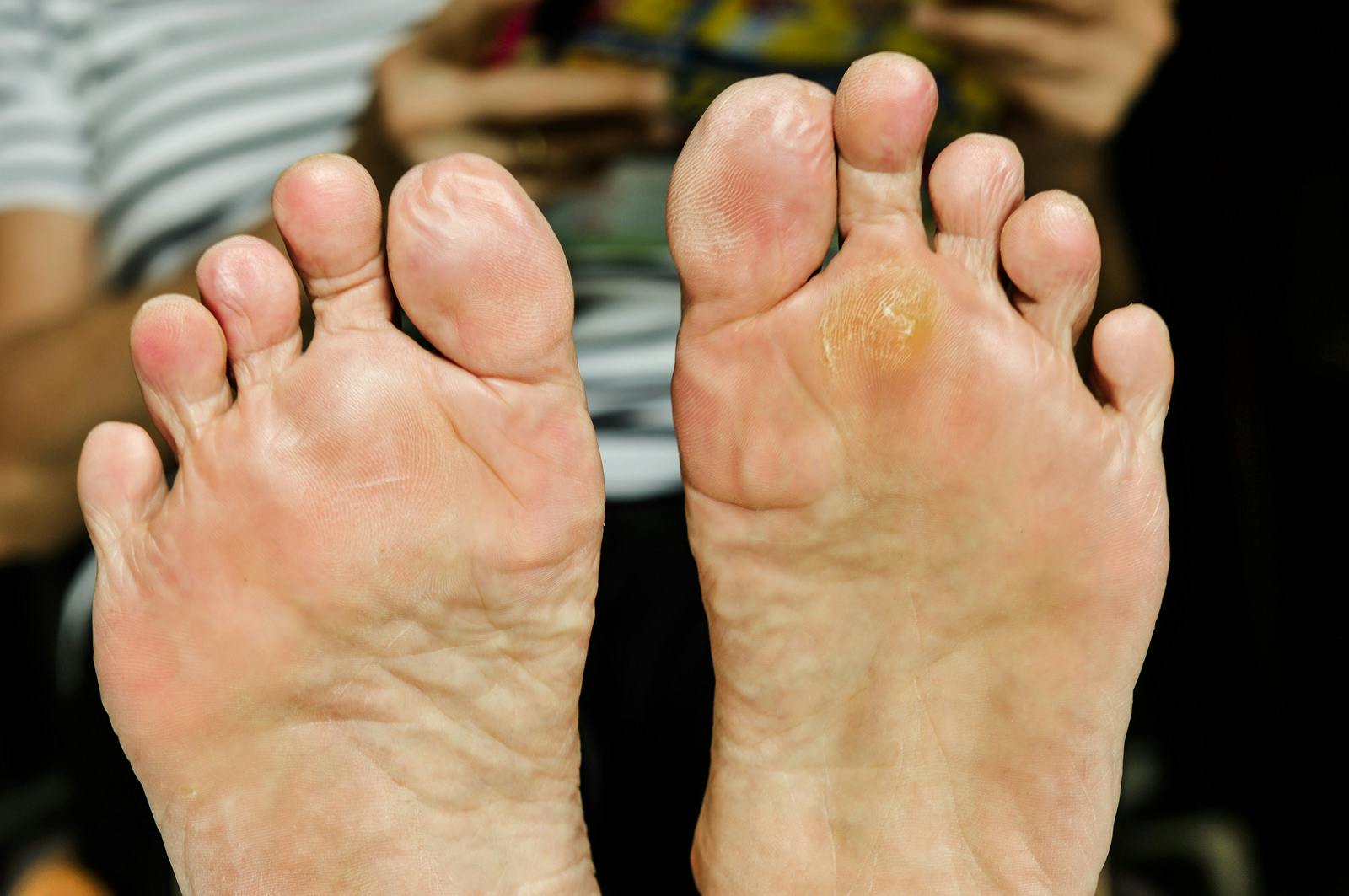treatment with salicylic acid to banish plantar warts on the soles of two feet
