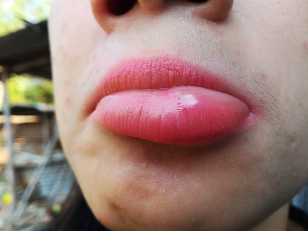 Detail of  female lips after bee stings
