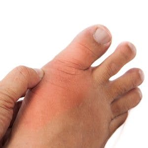 Hand embracing foot with deformed right toe due to painful gout inflammation
