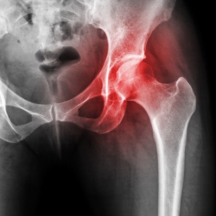 Arthritis at hip joint . Film x-ray show inflamed of hip joint and blank area at right side . Avascular necrosis concept .
