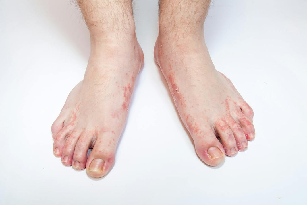 Dermatitis on foot athlete&#8217;s foot disease problem

