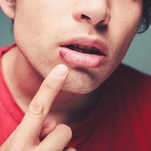 Young man is showing a cold sore on his lip
