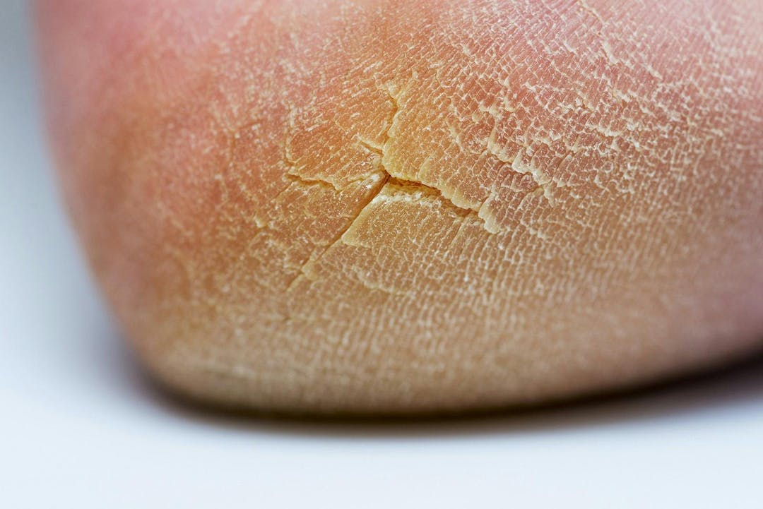 Cracked heel. Close up of a person with dry skin on heel.
