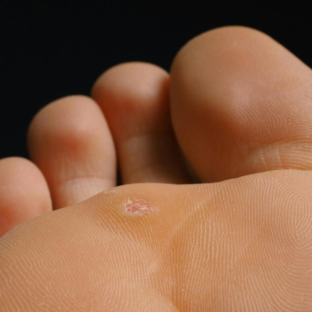 Closeup of foot with a infected wart placed under toes isolated towards black
